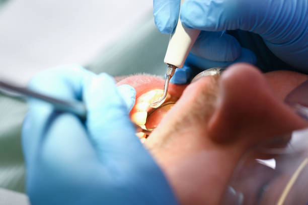 Best Emergency Wisdom Tooth Extraction in Scottdale, PA